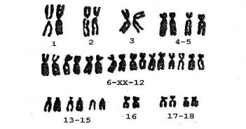 Хромосомные болезни связанные с изменением числа хромосом у человека